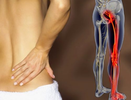 What can I do about my sciatica-pain?